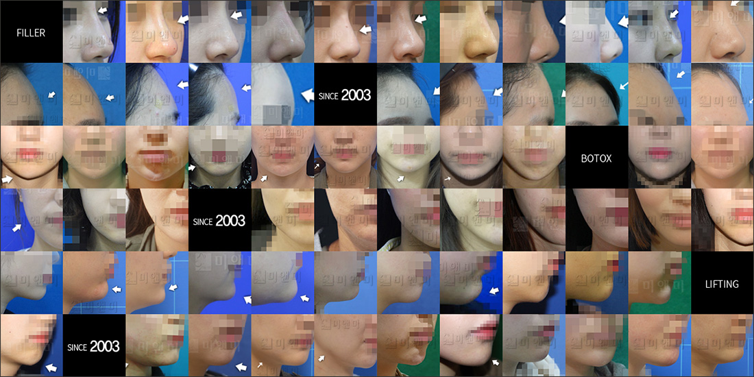 SINCE 2003 MI&MI, 시술후사진모음 송파레이저리프팅, 문정레이저리프팅