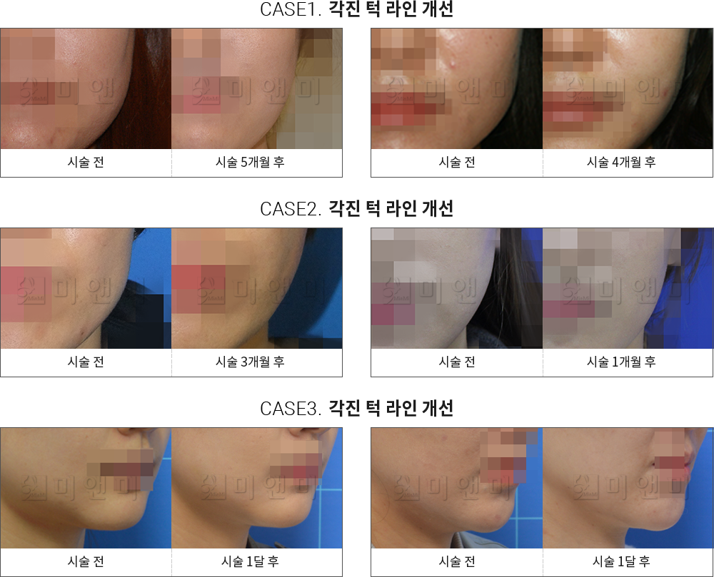 시술전후사진 사각턱 보톡스 : 각진 턱 라인 개선 송파사각턱보톡스, 문정사각턱보톡스