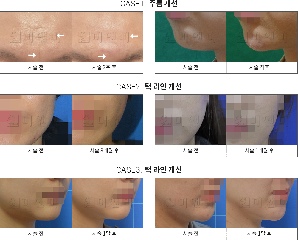 시술전후사진 주름 보톡스 : 주름 개선, 턱 라인 개선 송파주름보톡스, 문정역주름보톡스