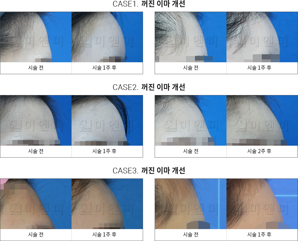 시술전후사진 이마필러 : 무턱개선 송파이마필러, 문정이마필러필러