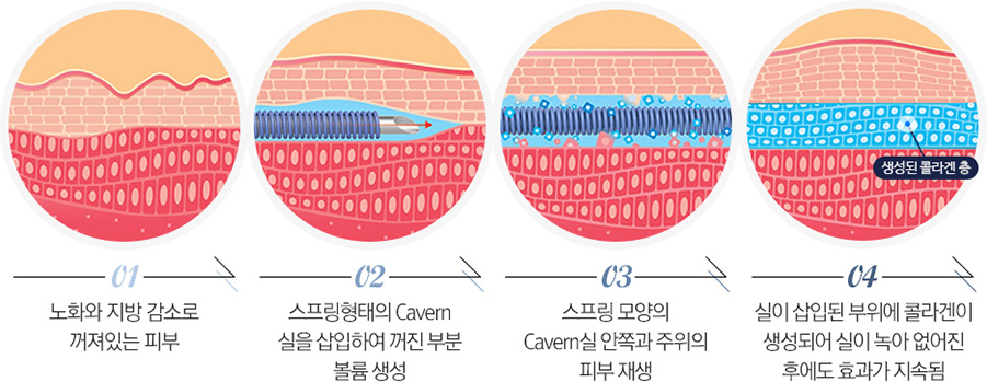 송파캐번리프팅,문정캐번리프팅